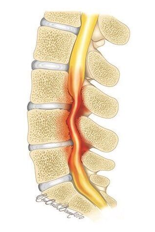 Com osteocondrose da coluna torácica, ocorre compressão do canal vertebral