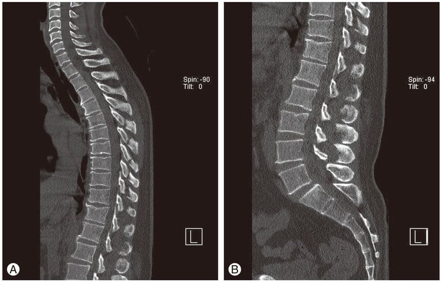 Deformação dos discos intervertebrais em imagens de ressonância magnética na osteocondrose torácica