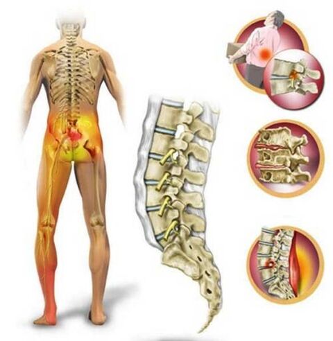 Osteocondrose da coluna lombar, causando dor nas costas