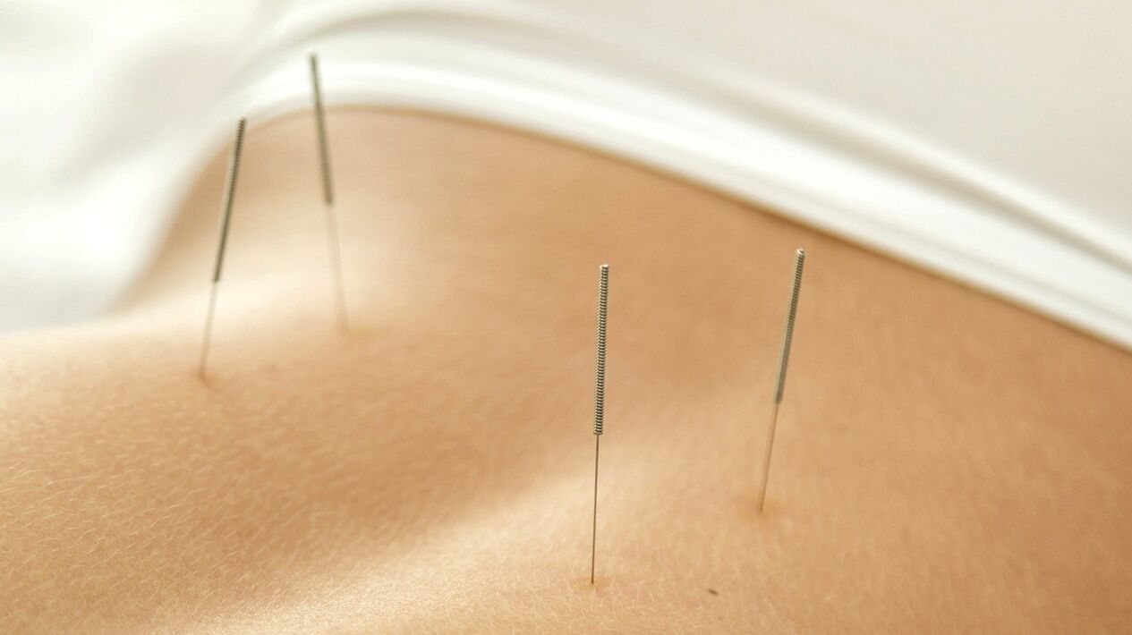 A acupuntura ajudará a se livrar da dor lombar
