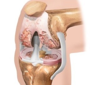 A cartilagem no joelho