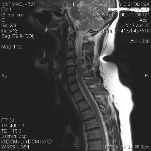 Osteocondrose e espondilose cervical da coluna vertebral